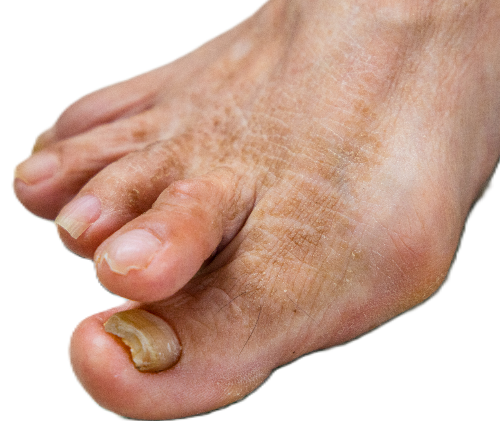 foot with flexible overlapping 2nd hammer toe
