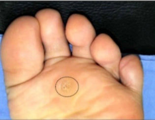 Bottom of forefoot with wart on n center of ball of foot circled 