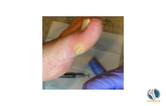 big toe with callus on side