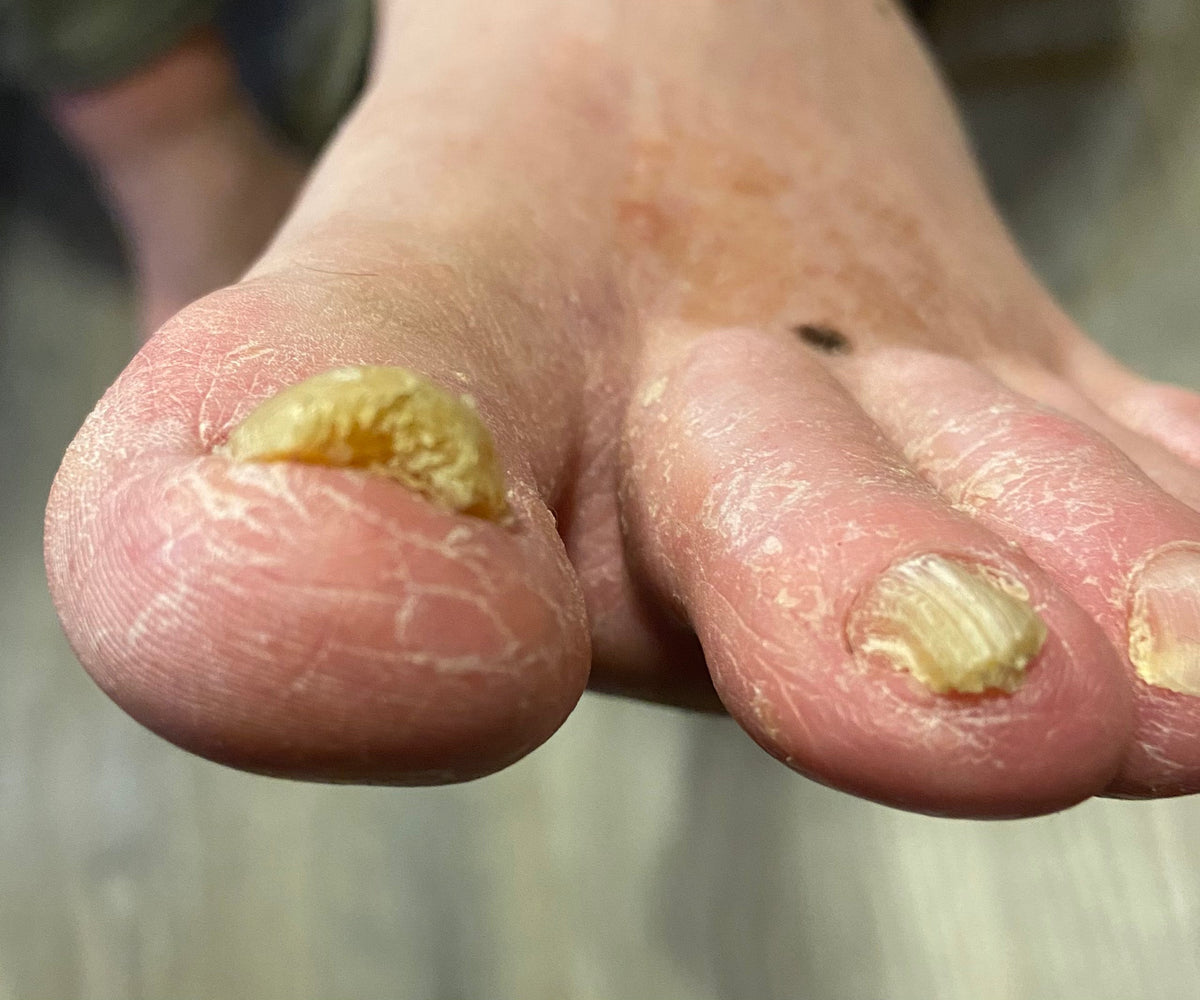 How to Get Rid of Thick or Discolored Toenails