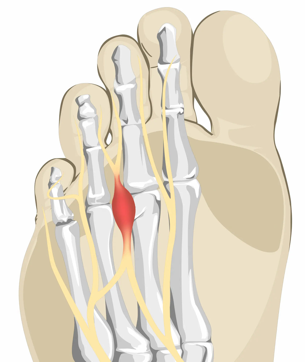 6 Signs of Morton's Neuroma and When to See a Podiatrist