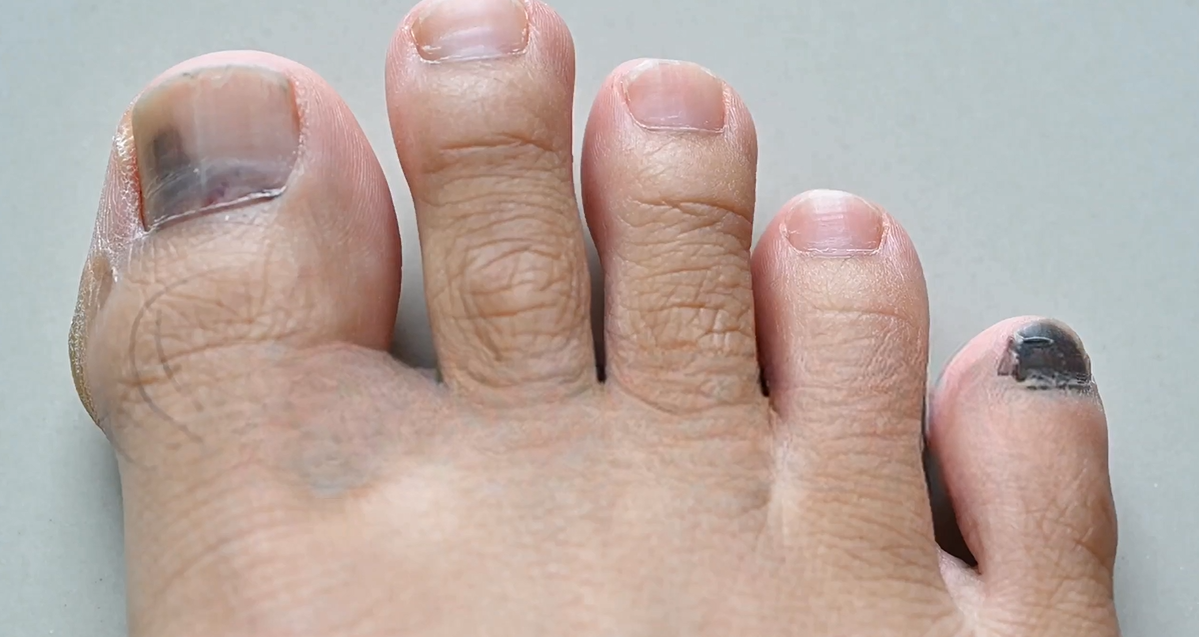 toes with black subungal hematoma / bruise on big toe and baby toe