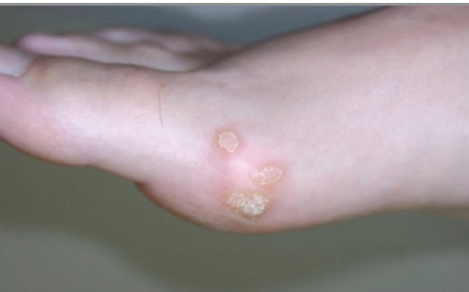 side of foot with 3 white lesions at big toe joint 