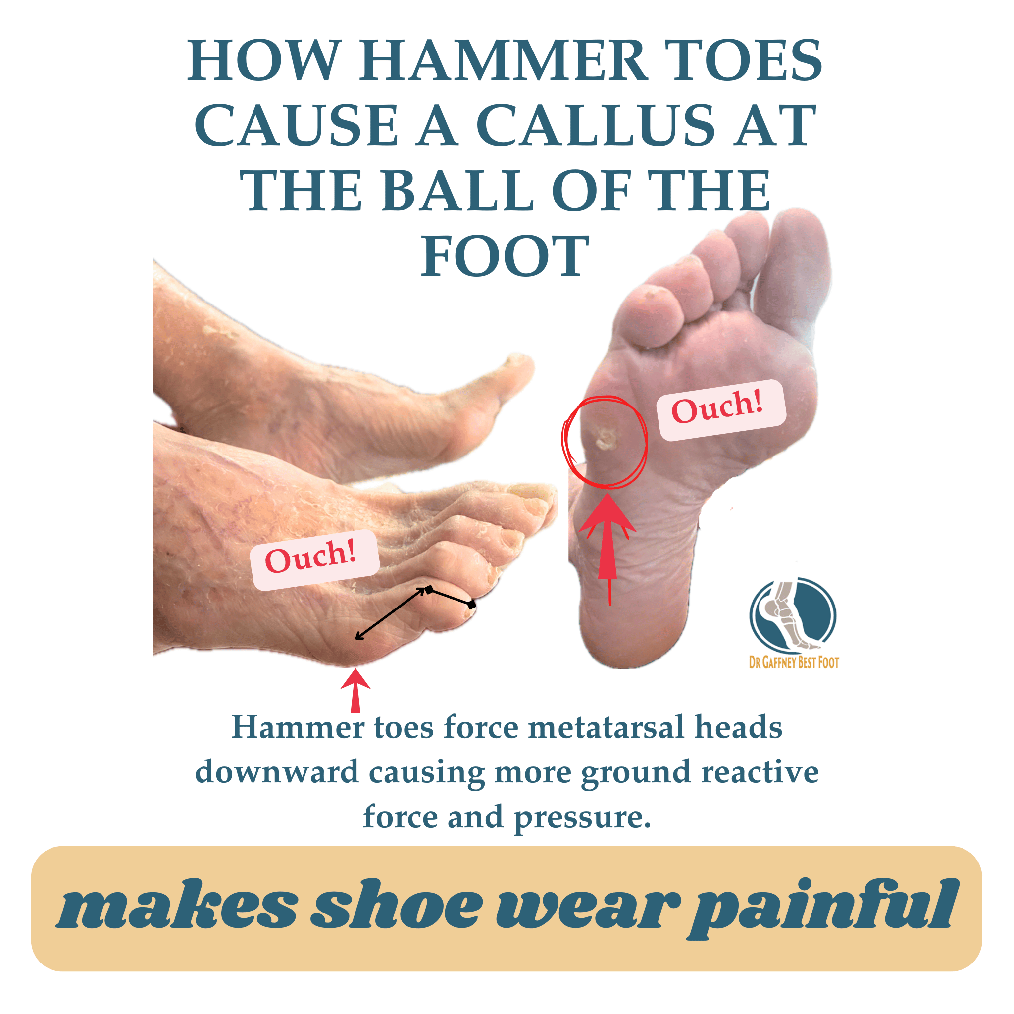 Callus pad on ball of 1 foot , silipos gel corn pad on other foot  with close-up views of the product.