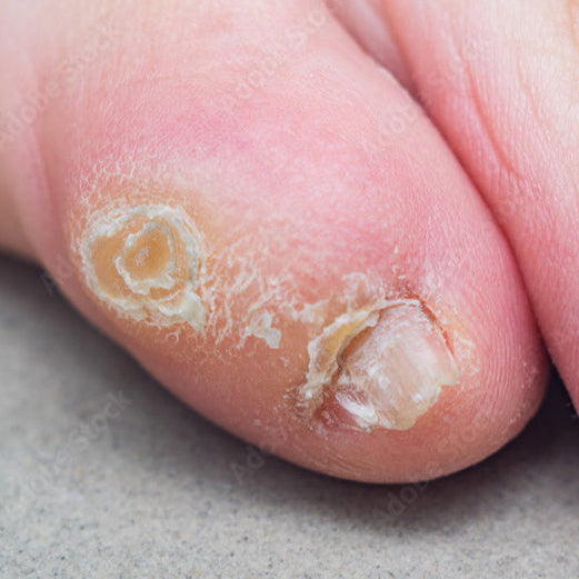 hard corn on baby toe