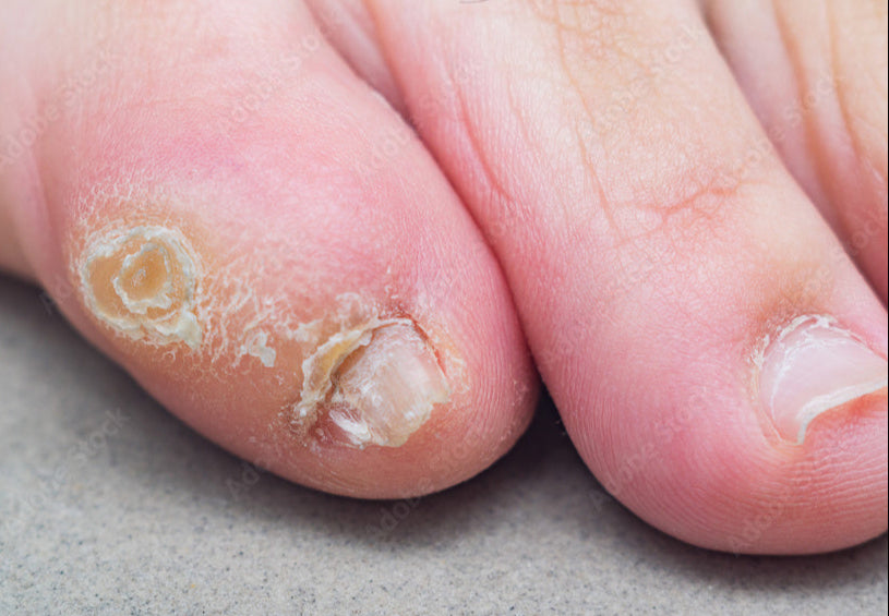 hard corn on baby toe