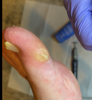 Close-up of a big toe callus and hand wearing a purple glove.
