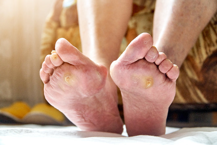 Close-up of feet with callus at ball and corn on tip of toe with a blurred background
